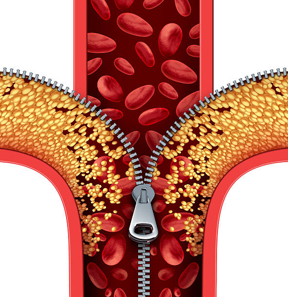 Atherosclerosis Therapy Atherosclerosis therapy cleaning arteries concept as a zipper opening up plaque buildup in a blocked artery as a symbol of medical treatment cleaning clogged veins as a metaphor for removing cholesterol. statin photos stock pictures, royalty-free photos & images