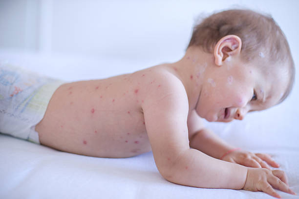 istock Baby girl with chickenpox 509480418