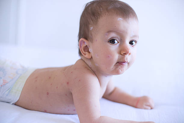 istock Baby girl with chickenpox 509480458