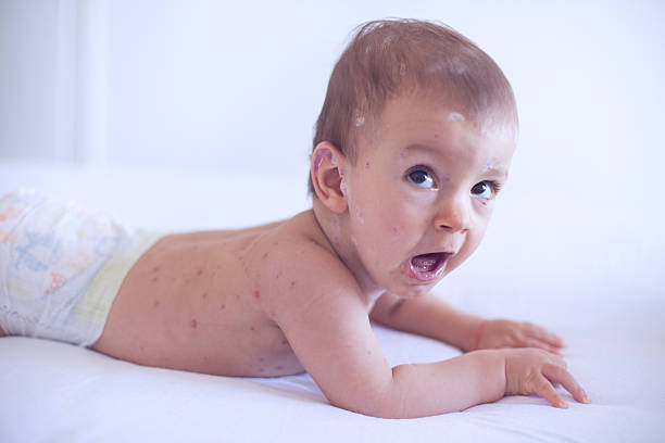 istock Baby girl with chickenpox 509480506
