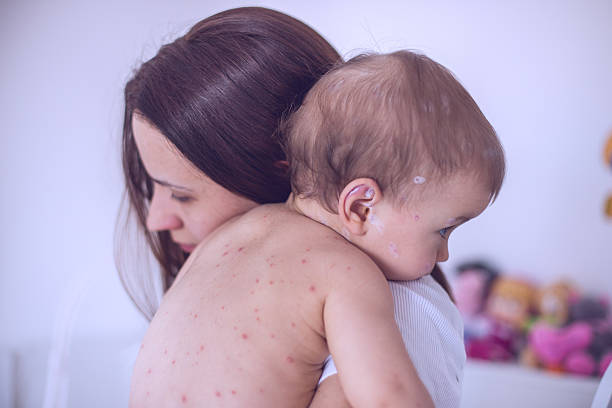 구슬눈꼬리 치료 아기 치킨 두창 - chickenpox skin condition baby illness 뉴스 사진 이미지