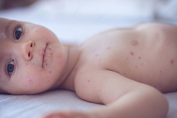 istock Baby girl with chickenpox 509481034