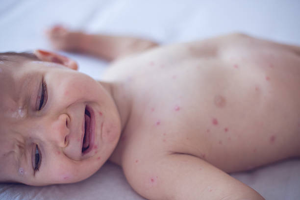 istock Crying baby girl with measles 509481102