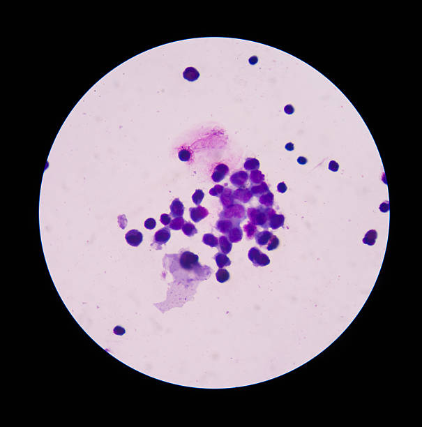 istock White blood cells  in wright staining in Cerebrospinal fluid 509532648