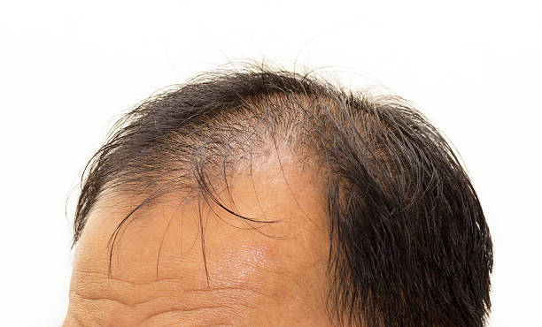 Male Head With Hair Loss Symptoms Front Side Stock Photo - Download Image  Now - Men, Adult, Brown - iStock