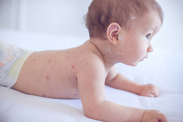 istock Baby girl with chickenpox 509670958