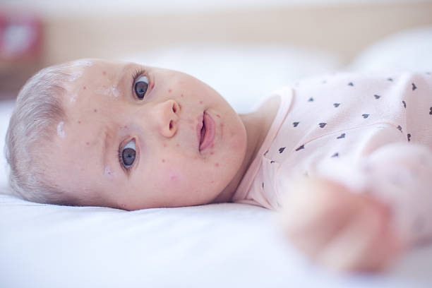 istock Baby girl with chickenpox 509672328