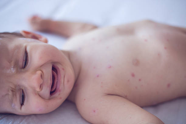 istock Crying baby girl with chickenpox 509672914