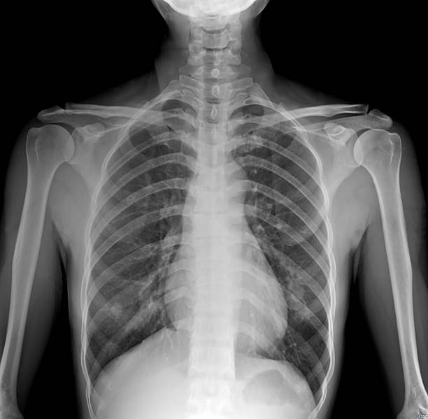 istock X-Ray Image Of Human Chest - TB screening 509684193