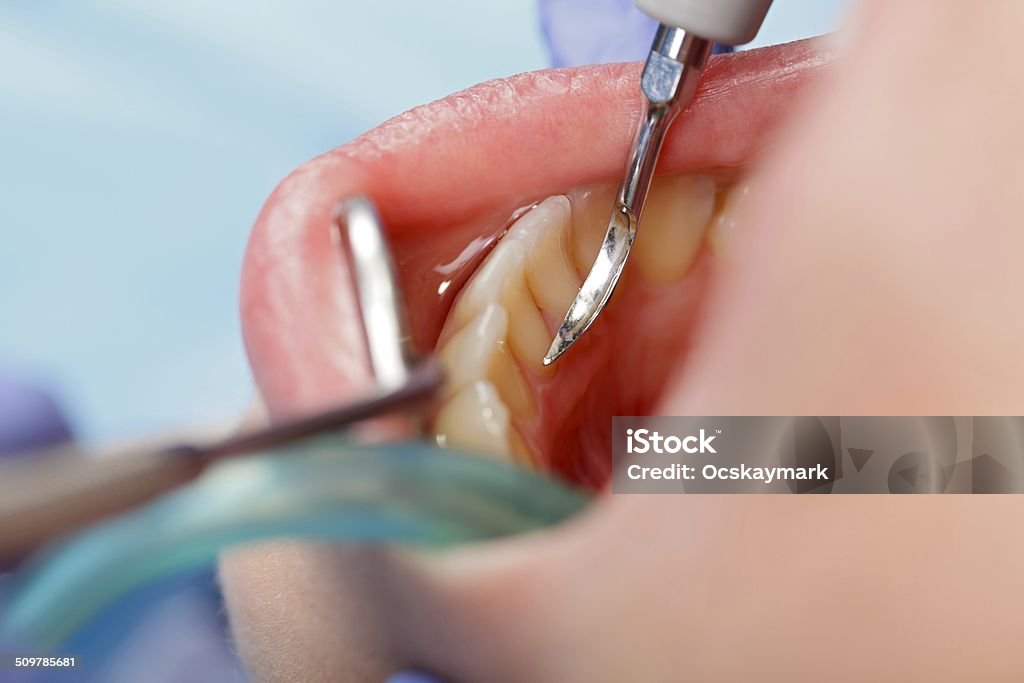 Dental calculus removing Close up of a dental calculus removing Measuring Stock Photo