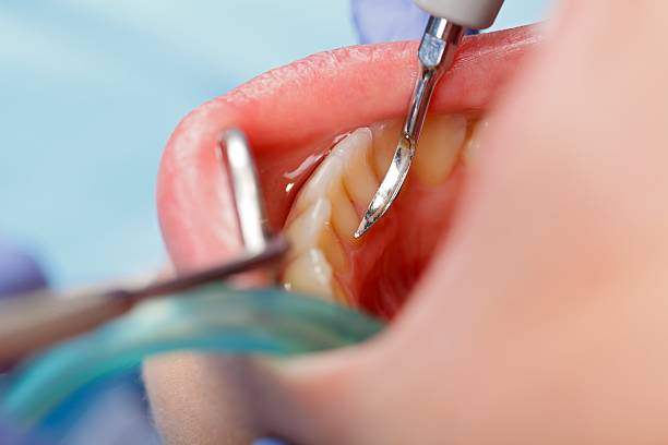 Dental calculus removing stock photo