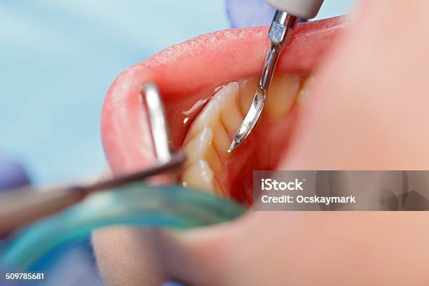 Dental Calculus Removing Stock Photo - Download Image Now - Measuring, Dental Calculus, Dental Health