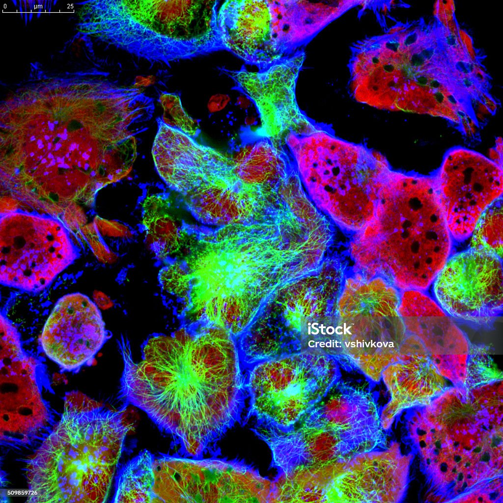 Tế bào khối u dưới kính hiển vi - Trả phí Bản quyền Một lần Tế bào ung thư Bức ảnh sẵn có Tế bào khối u dưới kính hiển vi - Trả phí Bản quyền Một lần Tế bào ung thư Bức ảnh sẵn có