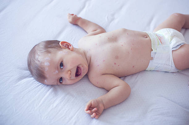 istock Baby girl with chickenpox 509933886