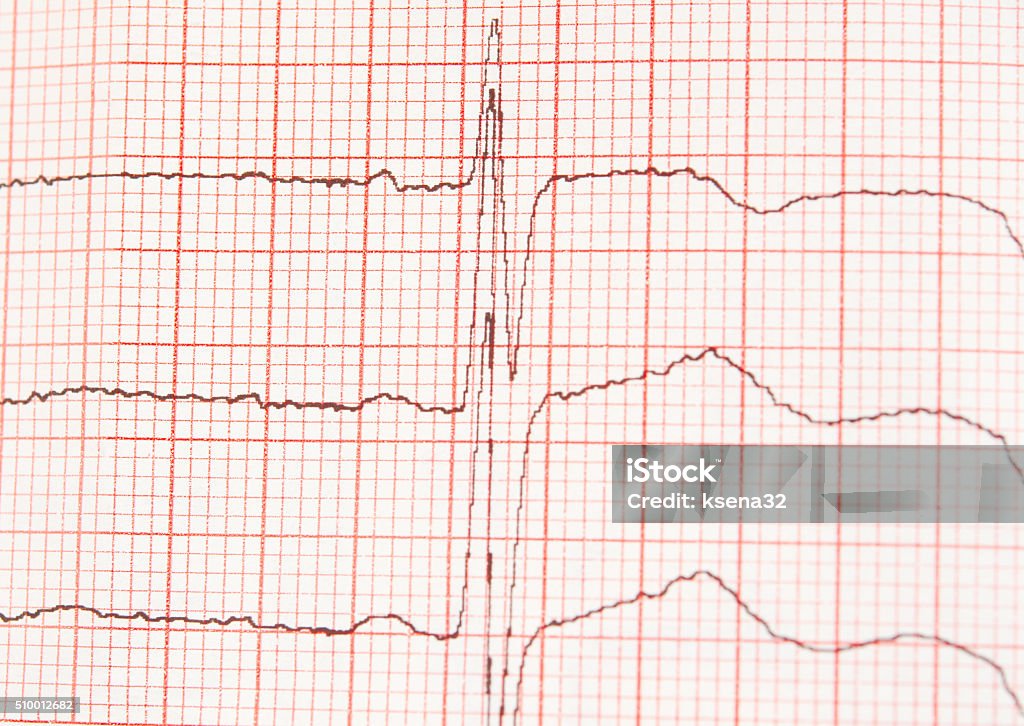 l ECG graph Photo of a real ECG graph Aorta Stock Photo