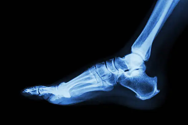 Photo of X-ray normal foot lateral