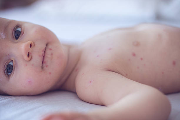 bambina con varicella - chickenpox skin condition baby illness foto e immagini stock