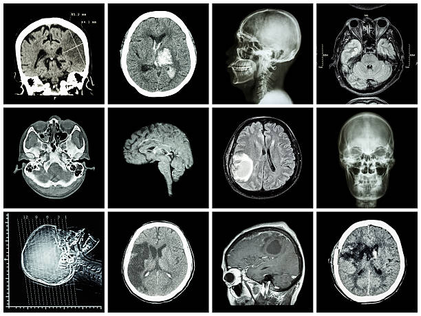 Collection of brain disease Collection of brain disease ( CT scan and MRI of brain : show cerebral infarct , intracerebral hemorrhage , brain tumor , basal ganglia hemorrhage ( status post craniotomy ) ) ( health care concept ) cerebrum stock pictures, royalty-free photos & images