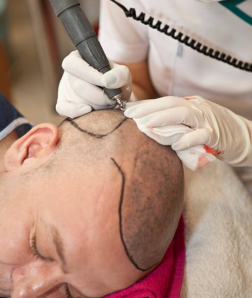 istock hair transplant 510332653