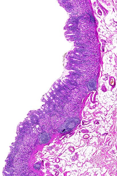 istock Chronic gastritis of a human 510388866