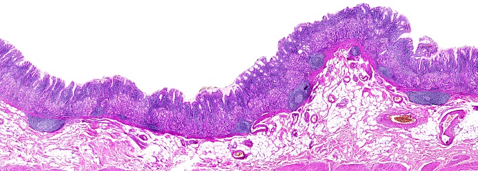 Chronic gastritis of a human, highly detailed panorama - 66 shots, 260 megapixels and after the reduced resolution. Photomicrograph as seen under the microscope, 10x zoom.