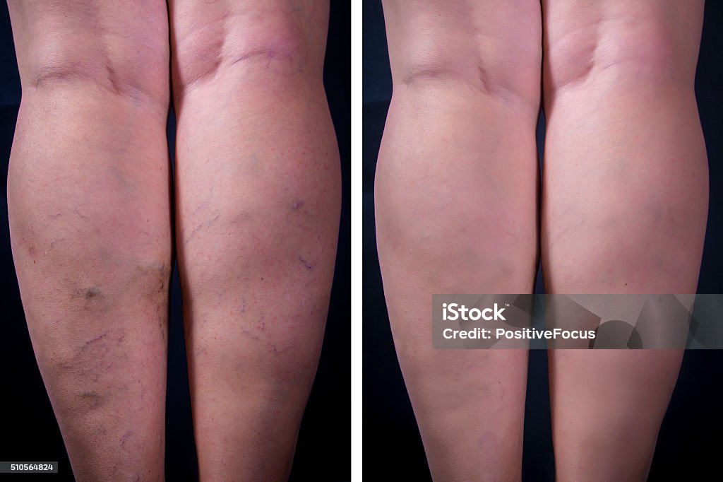 Varicose veins Varicose veins on dark background. Before and after. Studio shot Varicose Vein Stock Photo