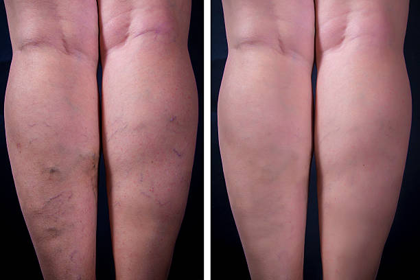 Varicose veins Varicose veins on dark background. Before and after. Studio shot leaf vein stock pictures, royalty-free photos & images