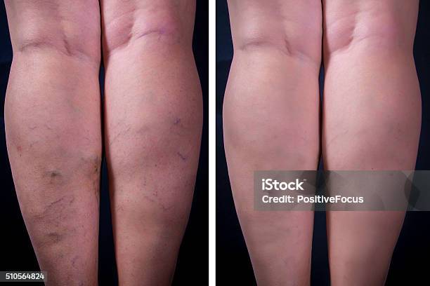 Varicose Veins Stock Photo - Download Image Now - Varicose Vein, Leaf Vein, Before and After