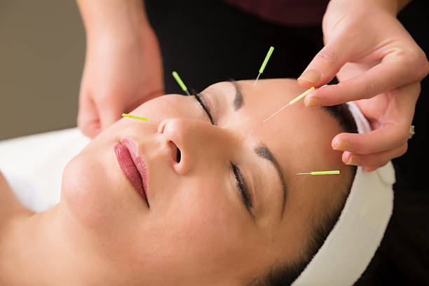 reife frau zu akupunktur-behandlung im spa - akupunkturnadel fotos stock-fotos und bilder