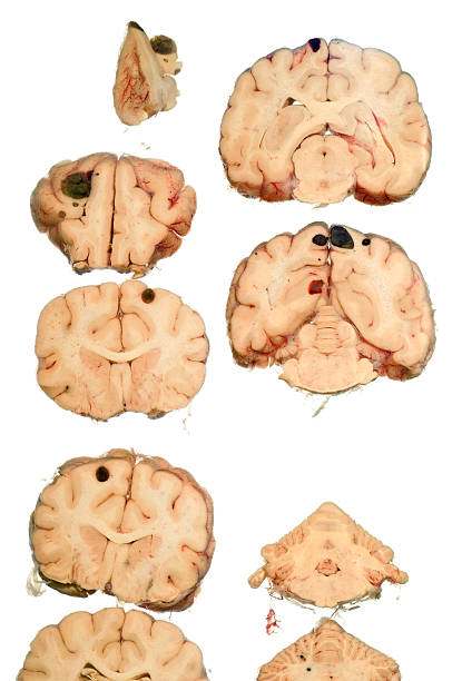 Cross section of a dogs brain. Metastasis of malign melanome in brain of Irish Setter (Male 12 years).