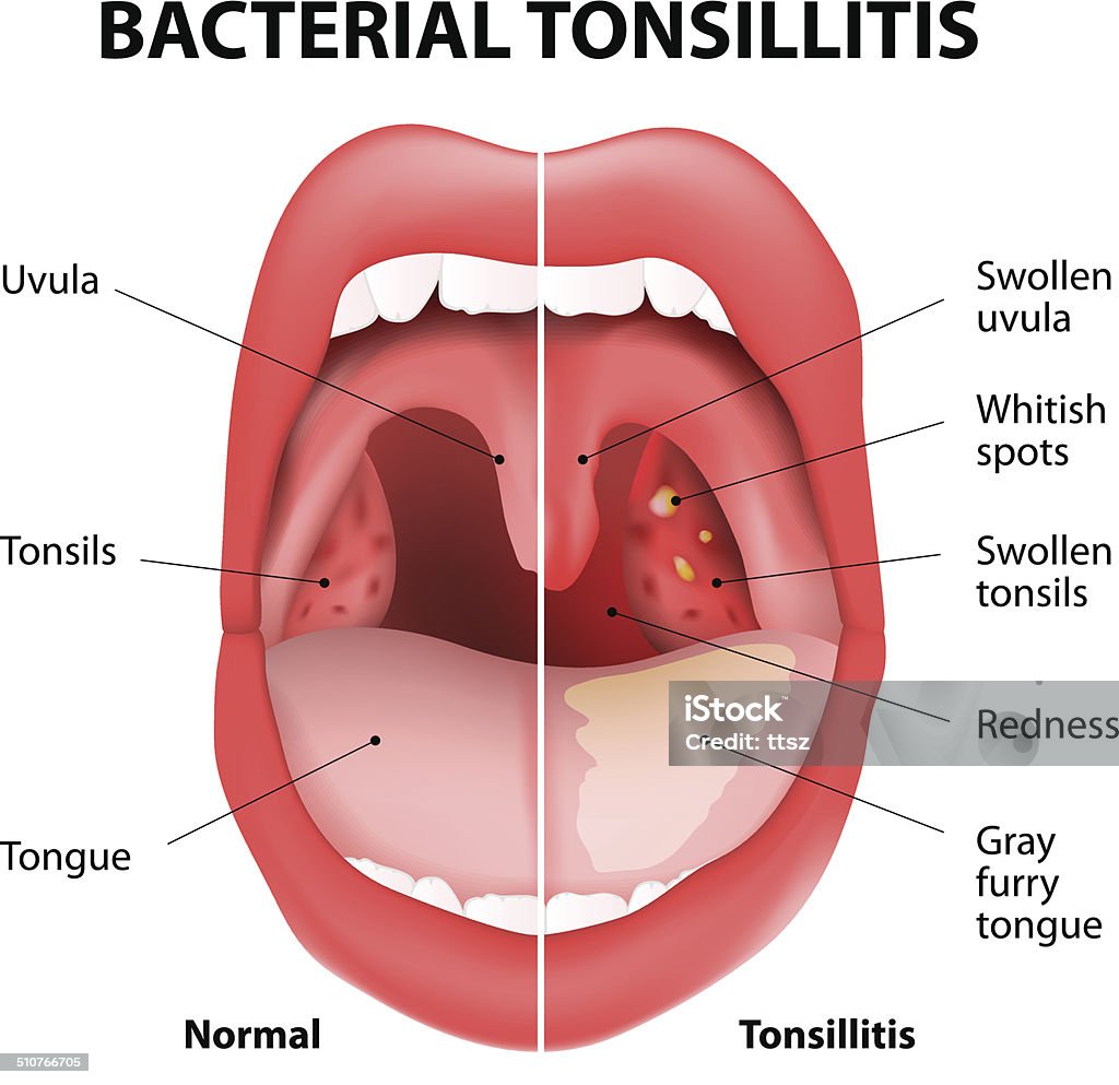 Amigdalitis bacteriana - arte vectorial de Absceso libre de derechos