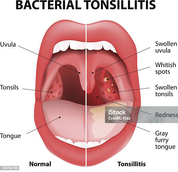 Ilustración de Amigdalitis Bacteriana y más Vectores Libres de Derechos de Absceso - Absceso, Anginas, Faringitis