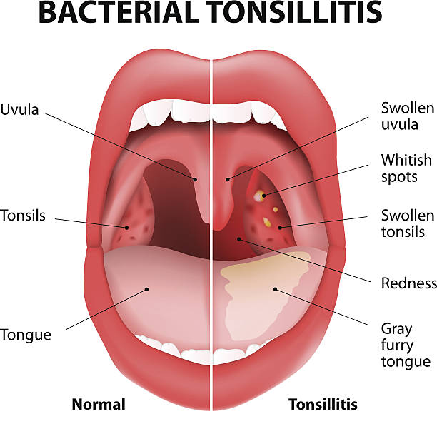 illustrazioni stock, clip art, cartoni animati e icone di tendenza di tonsillite batterica - citomegalovirus