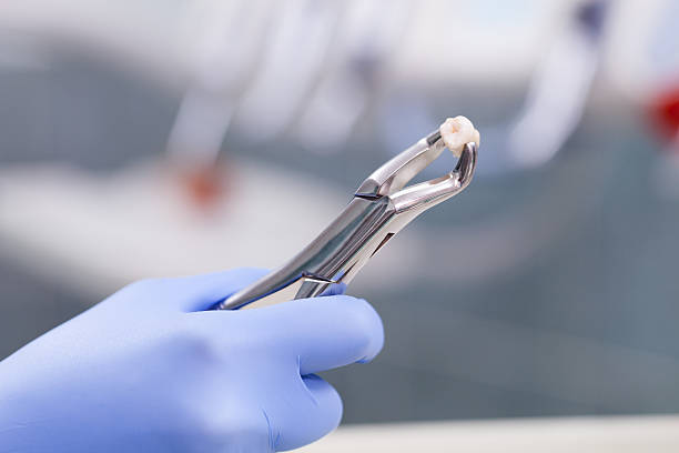 Tooth extraction stock photo