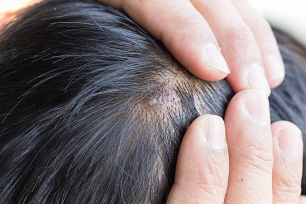 istock skin disease on the head 510778784
