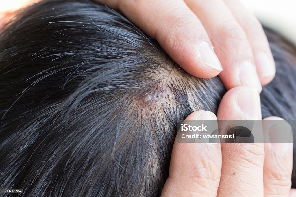 skin disease on the head Adult Stock Photo