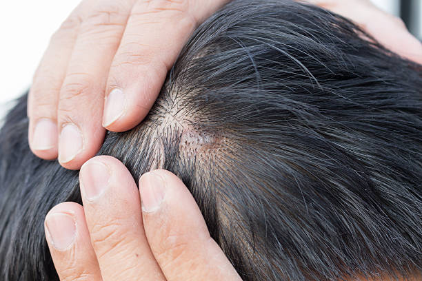 istock skin disease on the head 510779728