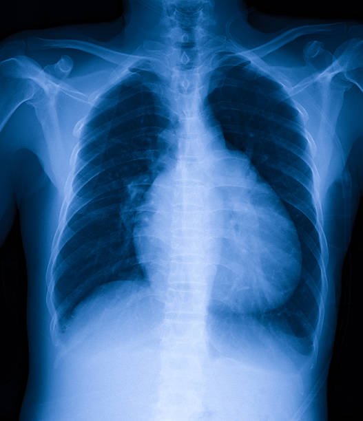 istock Chest X-ray image shows enlarged heart 510855992