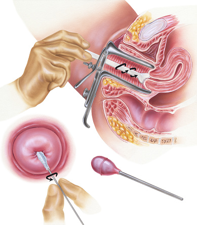 Papanicolaou (Pap) smear. Shown are a cervical scrape smear (top), a cervical swab smear (bottom left), and an endocervical aspirator (bottom right). A Pap smear is used to detect cervical intraepithelial neoplasia (dysplasia), cervical cancer, vaginal neoplastic cells, condyloma (human papilloma virus, or HPV), trichomoniasis, and herpes.