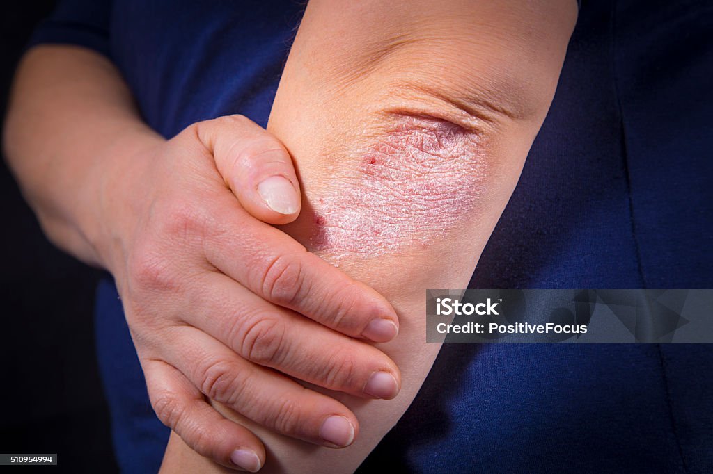 Psoriasis on elbow Psoriasis on elbows. Black background Psoriasis Stock Photo