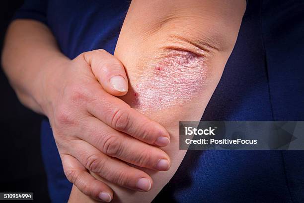Psoriasis On Elbow Stock Photo - Download Image Now - Psoriasis, Elbow, Eczema