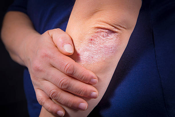 псориаз на локтях - dermatitis dry human hand human skin стоковые фото и изображения