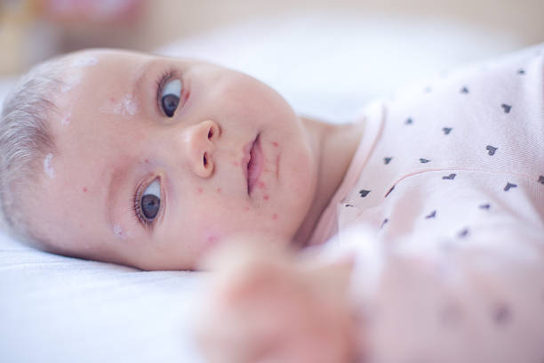 istock Baby girl with chickenpox 510961614