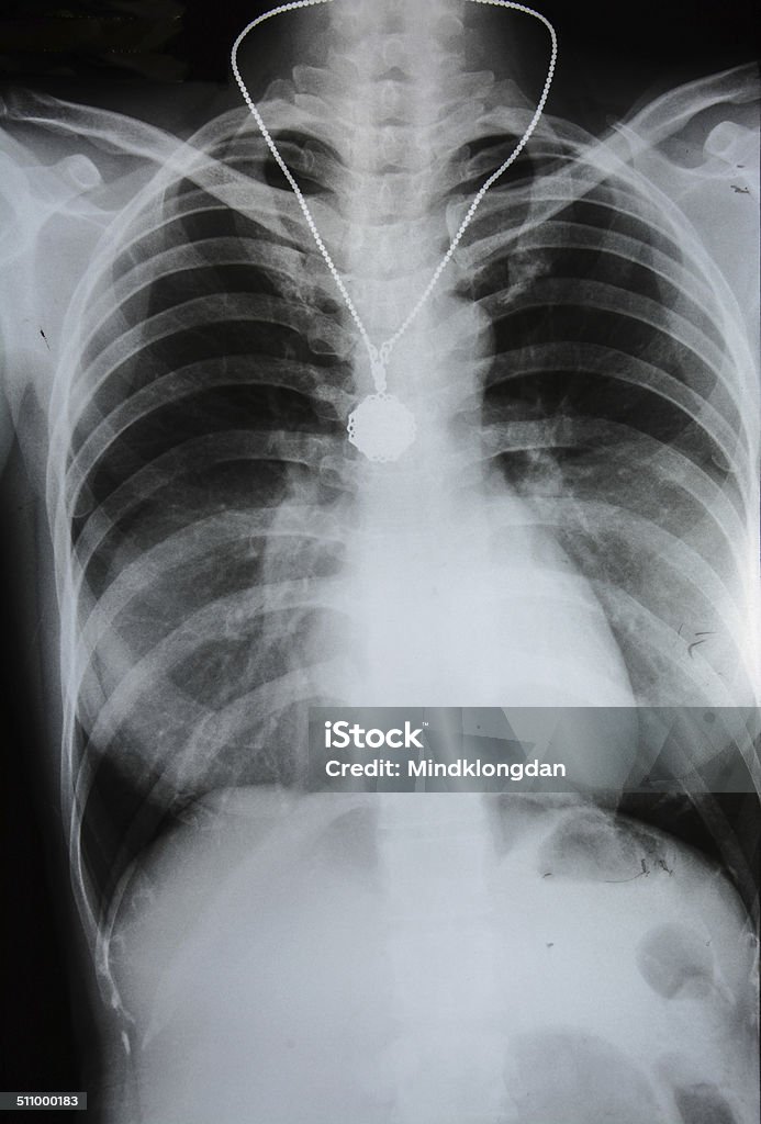 Imagem de raios X de homem do peito - Foto de stock de Abdome royalty-free