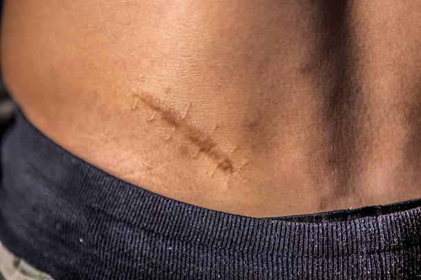 istock Body Of The Scar 511059582