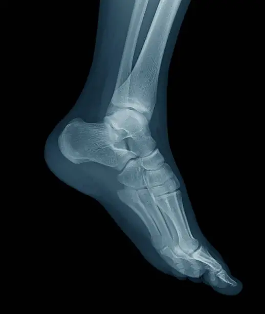 Photo of Digital X-ray image of a young foot, oblique view.