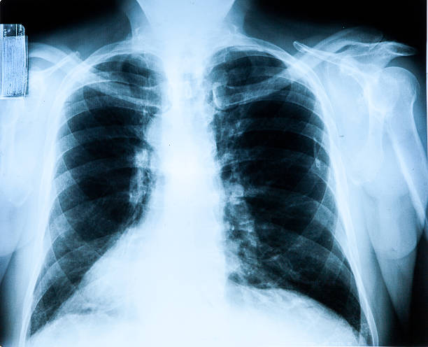 istock X-Ray MRI Image Of Human Chest 511643591