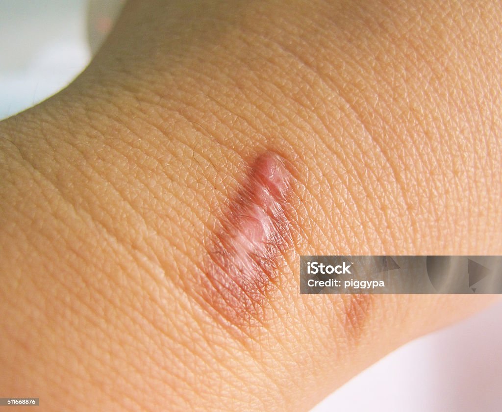 Scar on human  skin Scar on human burned skin from hot water scald, selective focus Scar Stock Photo