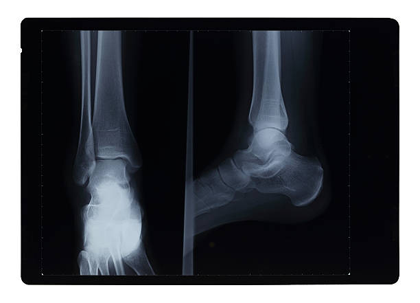 Broken Leg Xray Stock Photos, Pictures & Royalty-Free Images - iStock Broken Leg Xray Stock Photos, Pictures & Royalty-Free Images - iStock