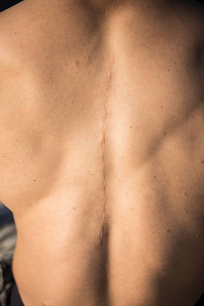 Scars on the back Back of back surgery patient scar surgery rear view human spine stock pictures, royalty-free photos & images